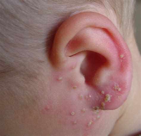 Folliculitis – Pictures, Types, Symptoms, Causes and Contagiousness