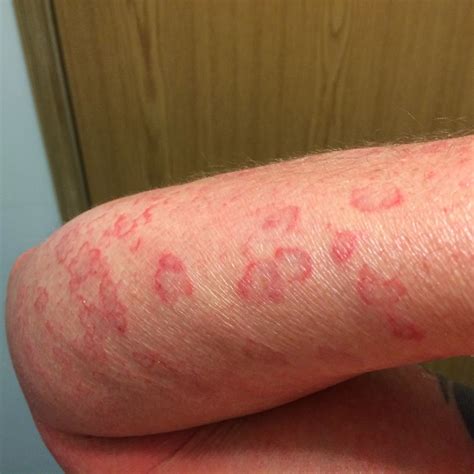 My pityriasis rubra pilaris blog: Scalp update