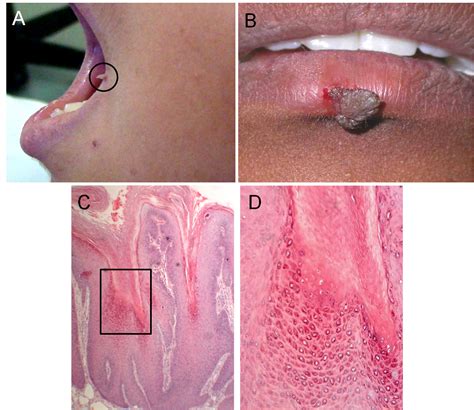 Hpv Corner Of Mouth Fordyce Spots: Symptoms, Causes & Treatment Tua