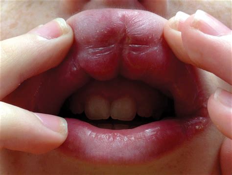 What Causes Swollen Lips And Fever at Justin Poole blog