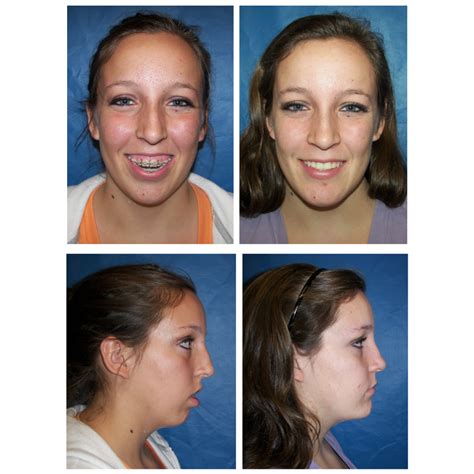 Does Tmj Surgery Change Your Face
