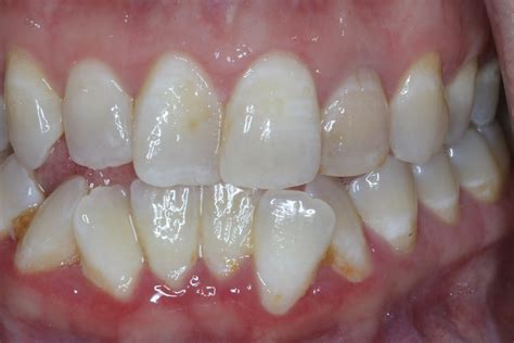 Image result for Discolored Tooth