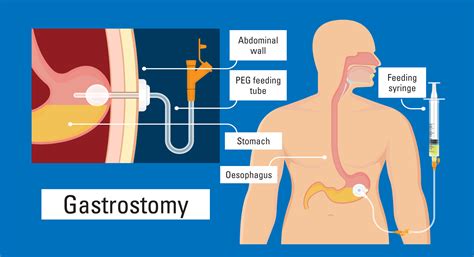 Percutaneous Endoscopic Gastrostomy Tube Placement Icd 10 - Printable ...