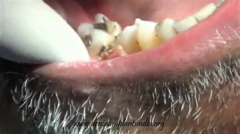 Image result for Abscess Tooth Extraction