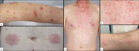 Myelodysplastic Syndrome Skin