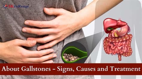 Gallbladder Stones Symptoms In Women