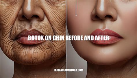 Botox on Chin Before and After: Ultimate Guide