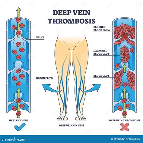 How Dangerous Is Deep Vein Thrombosis