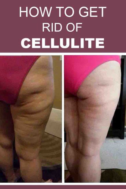Image result for How to Remove Cellulite Fast