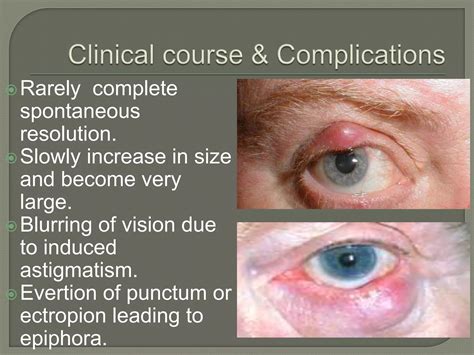 Eyelid Disorders.pptx