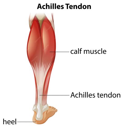 Achilles Tendon Partial Tear