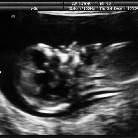 Kidney Stones During Pregnancy