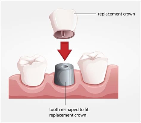 Dental Crown Procedure: Know How It's Done in Media, PA