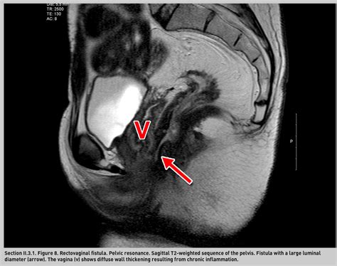 Fistula Perianal Ressonancia Magnetica Perianal Fistula | Radiology