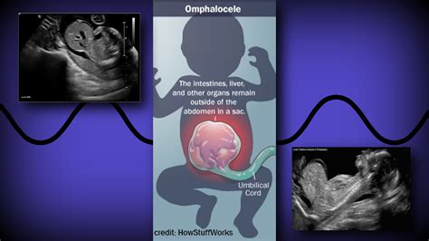 Omphalocele vs. Gastroschisis – Sonographic Tendencies
