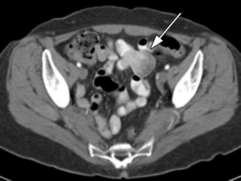 Small Bowel Neoplasms: A Pictorial ReviewRadioGraphics