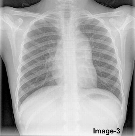 Chest X Ray Pediatric Pneumonia at Imogen Parry-okeden blog