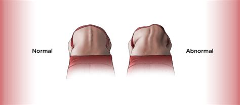 What Are the Signs of Scoliosis in Children? | Children's Healthcare of ...
