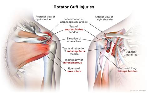 Most Comfortable Position For Rotator Cuff Injury at Ida Barrera blog