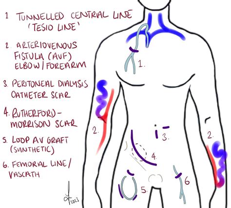 Abdominal Incisions - Lanz - Kocher - Midline - TeachMeSurgery