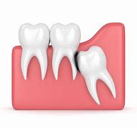 Image result for wisdom tooth 智齿也叫智慧齿