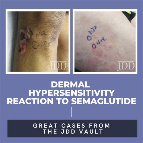 Dermal Hypersensitivity Reaction to Semaglutide: Two Case Reports ...
