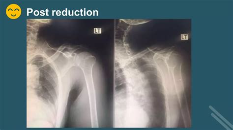 Ortho conference - anterior shoulder dislocation | PPT