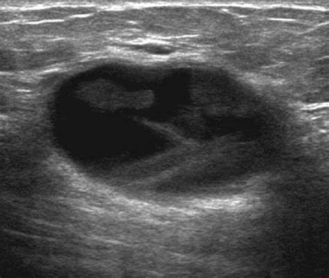 Breast Cyst Ultrasound
