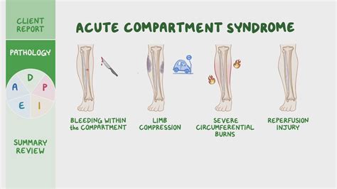 Compartment Syndrome Nursing Care Plans Diagnosis And - vrogue.co