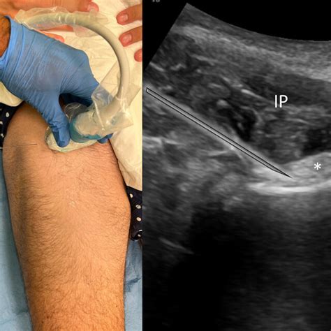 How to Perform Hip Ultrasound 的图像结果