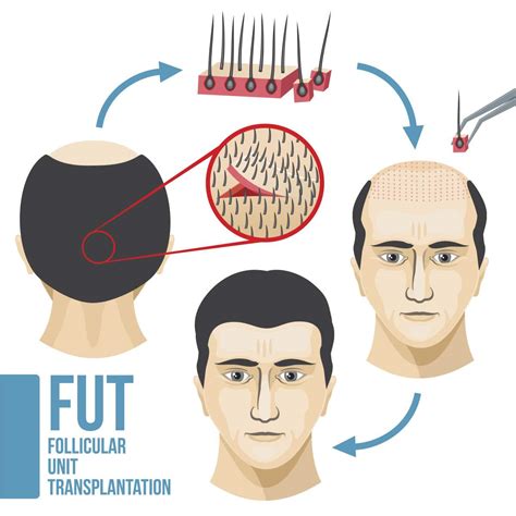 17 best Hair Restoration - FUE Hair Transplants in Toronto images on ...