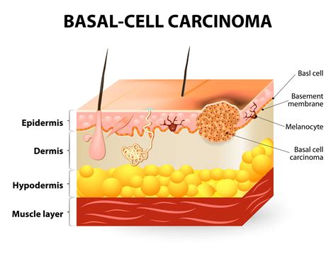 Basal Cell Carcinoma Vs Squamous at Scarlett Packham blog