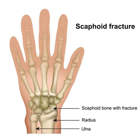 Scaphoid Fracture of the Wrist - Physioflow PT | Physical Therapy ...