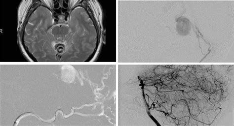 Ruptured Dural AV Fistula/AVM of the Posterior Fossa | NSPC Brain ...