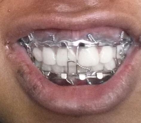 Through the Wire: Journey With My Jaw Wired Shut and After Jaw Surgery