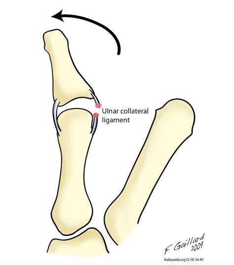 Ulnar collateral ligament (UCL) injury of thumb – The Lothian Hand Unit