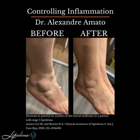 Learn About Lipedema Nutrition Before Surgery | Lipedema.Net