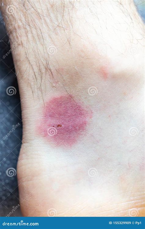 Flea Allergy Dermatitis On Humans