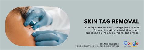 Skin Tag Removal – Quick, Painless & Scar-Free Solutions