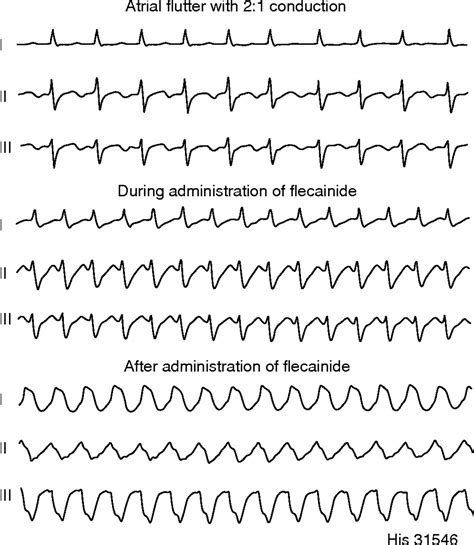 Approach to wide complex tachycardias in patients without structural heart disease | Heart