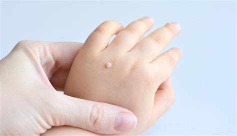 Mole and Wart Removal Treatment in Pragathi Nagar, Kukatpally | Dr ...