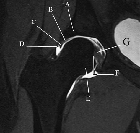Mri Anatomy Of Hip Joint Hip Avascular Necrosis, Osteonecrosis In NYC