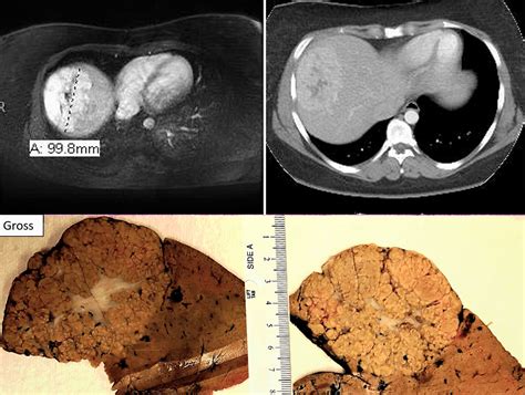Focal Nodular Hyperplasia Gross