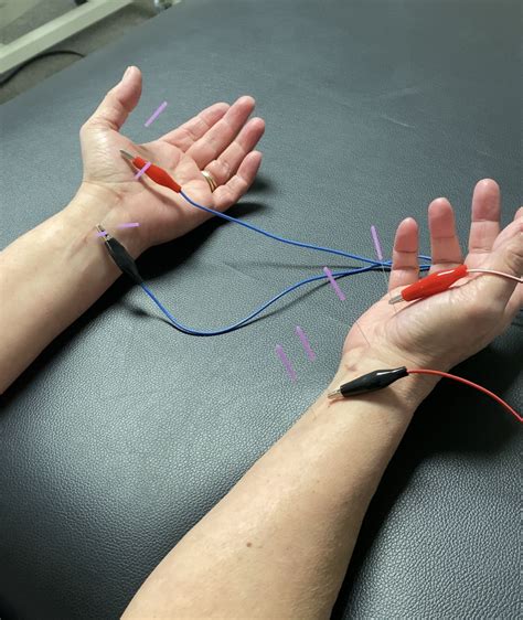 Carpal Tunnel Trigger Points