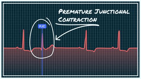 What Premature Junctional Contraction (PJC) Looks Like on Your Watch ...