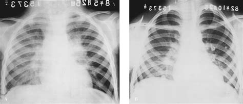 成人肺结核与肺癌的CT特征性表现及影像鉴别