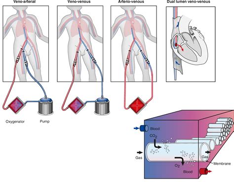 Figure 1 from Extracorporeal life support in critically ill adults ...