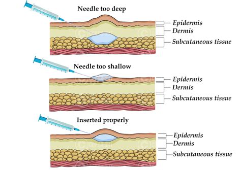Layers Of Skin For Injection at Cheryl Allison blog
