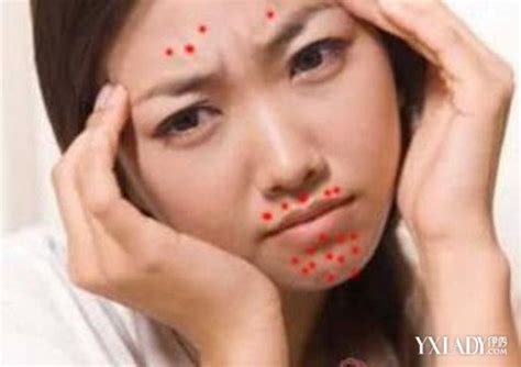 【图】男生嘴巴周围长痘痘是什么原因 6个方法帮你轻松祛痘(2)_伊秀美容网|yxlady.com
