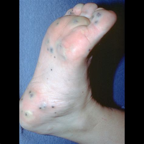 Blue Rubber Bleb Nevus Syndrome | Pediatric Radiology Reference Article ...